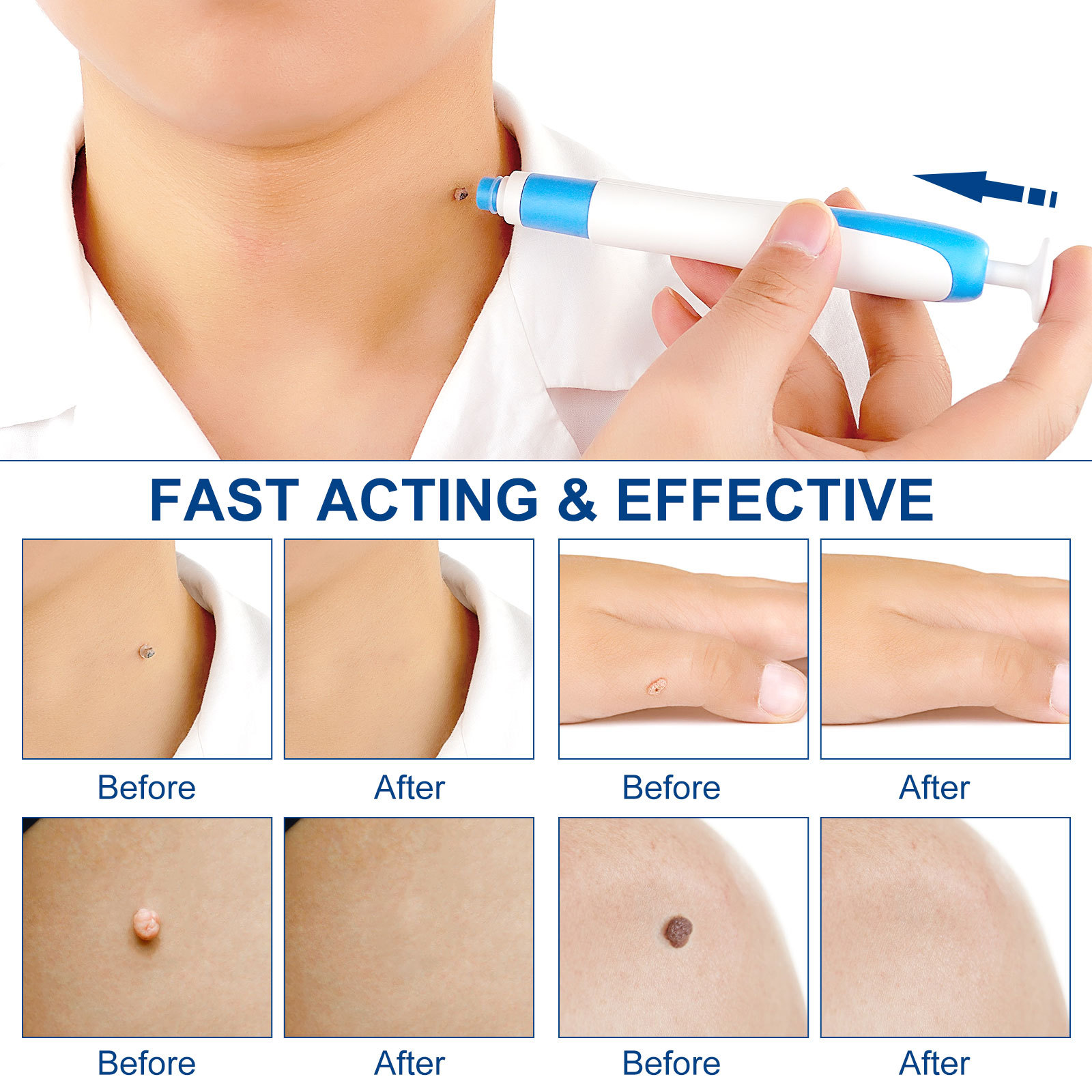 2-IN-1 Auto Skin Tag Removal K - đánh giá và giá Home Improvement And Tools