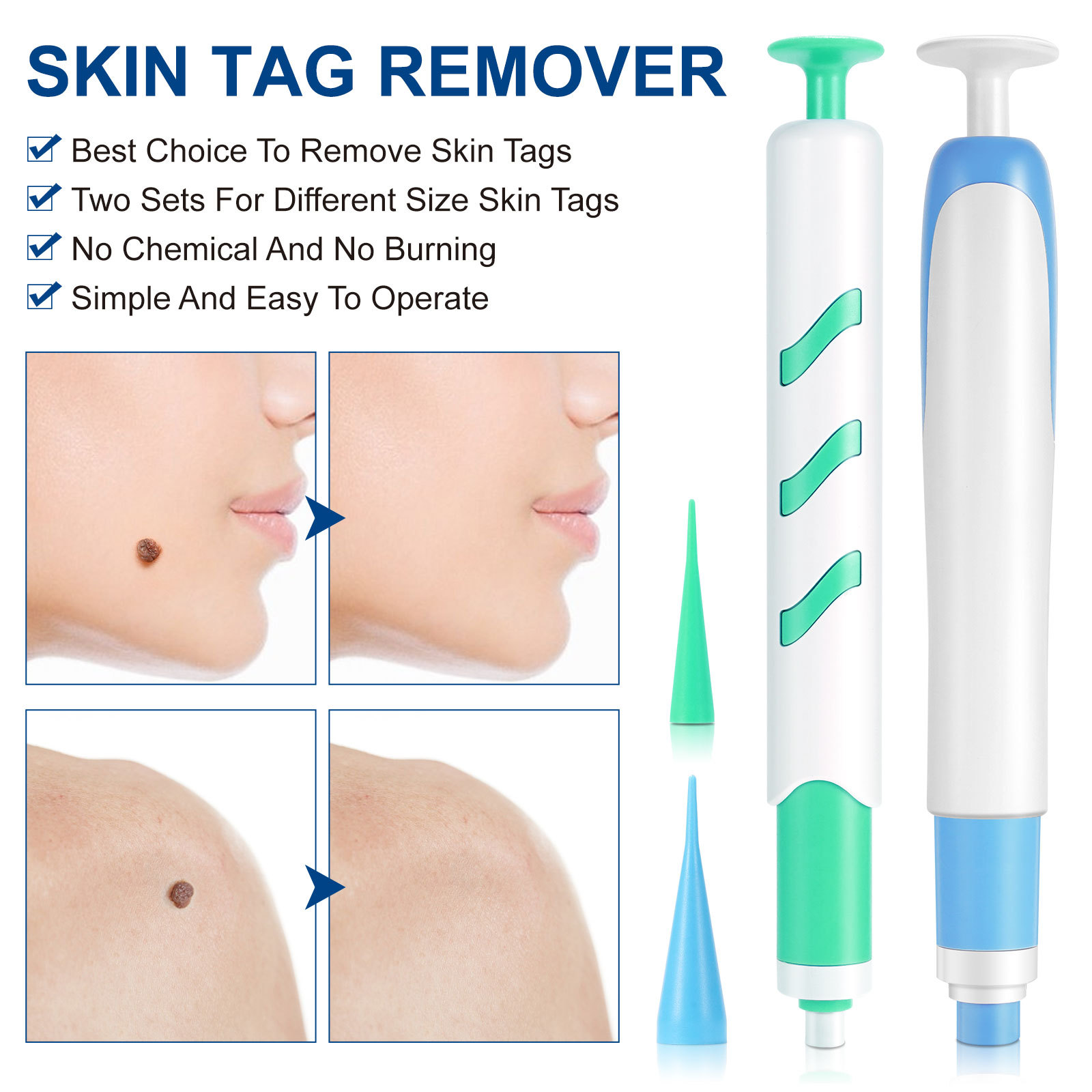 2-IN-1 Auto Skin Tag Removal K - đánh giá và giá Home Improvement And Tools